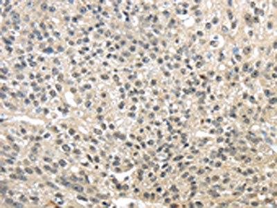 The image on the left is immunohistochemistry of paraffin-embedded Human breast cancer tissue using CSB-PA917113(TMED3 Antibody) at dilution 1/25, on the right is treated with fusion protein. (Original magnification: x200)