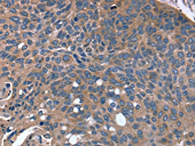 The image on the left is immunohistochemistry of paraffin-embedded Human esophagus cancer tissue using CSB-PA920081(RGS4 Antibody) at dilution 1/30, on the right is treated with fusion protein. (Original magnification: x200)