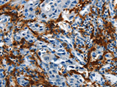 The image on the left is immunohistochemistry of paraffin-embedded Human lung cancer tissue using CSB-PA922324(IL20RA Antibody) at dilution 1/35, on the right is treated with fusion protein. (Original magnification: x200)