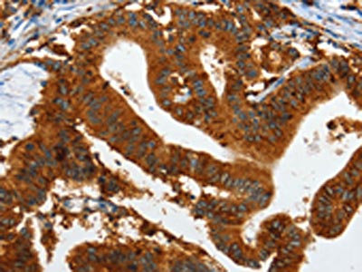 The image on the left is immunohistochemistry of paraffin-embedded Human colon cancer tissue using CSB-PA922324(IL20RA Antibody) at dilution 1/35, on the right is treated with fusion protein. (Original magnification: x200)