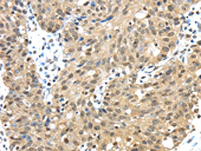 The image on the left is immunohistochemistry of paraffin-embedded Human breast cancer tissue using CSB-PA925902(TMED3 Antibody) at dilution 1/30, on the right is treated with fusion protein. (Original magnification: x200)