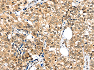 The image on the left is immunohistochemistry of paraffin-embedded Human breast cancer tissue using CSB-PA926943(TPR Antibody) at dilution 1/20, on the right is treated with synthetic peptide. (Original magnification: x200)