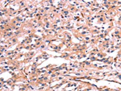 The image on the left is immunohistochemistry of paraffin-embedded Human thyroid cancer tissue using CSB-PA930240(PTPN13 Antibody) at dilution 1/30, on the right is treated with synthetic peptide. (Original magnification: x200)