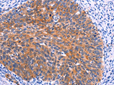 The image on the left is immunohistochemistry of paraffin-embedded Human cervical cancer tissue using CSB-PA930240(PTPN13 Antibody) at dilution 1/30, on the right is treated with synthetic peptide. (Original magnification: x200) The image on the left is immunohistochemistry of paraffin-embedded Human cervical cancer tissue using CSB-PA930240(PTPN13 Antibody) at dilution 1/30, on the right is treated with synthetic peptide. (Original magnification: x200)