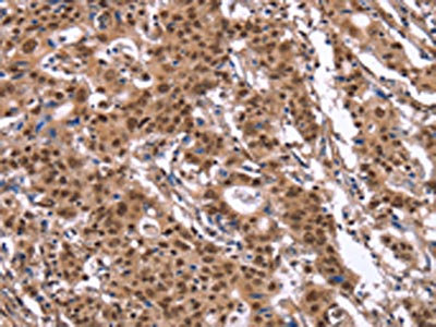 The image on the left is immunohistochemistry of paraffin-embedded Human gastic cancer tissue using CSB-PA935129(ID4 Antibody) at dilution 1/40, on the right is treated with synthetic peptide. (Original magnification: x200)