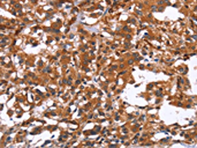 The image on the left is immunohistochemistry of paraffin-embedded Human thyroid cancer tissue using CSB-PA945843(GPHN Antibody) at dilution 1/15, on the right is treated with synthetic peptide. (Original magnification: x200)