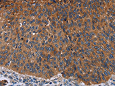 The image on the left is immunohistochemistry of paraffin-embedded Human lung cancer tissue using CSB-PA950440(JUP Antibody) at dilution 1/50, on the right is treated with fusion protein. (Original magnification: x200)