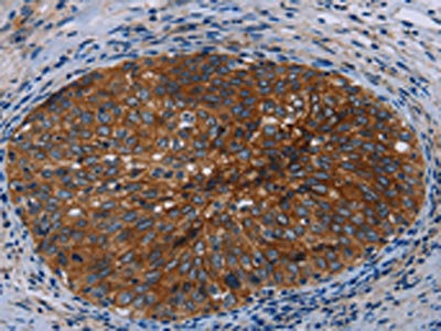 The image on the left is immunohistochemistry of paraffin-embedded Human cervical cancer tissue using CSB-PA950440(JUP Antibody) at dilution 1/50, on the right is treated with fusion protein. (Original magnification: x200)