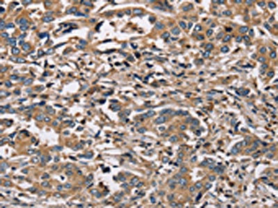 The image on the left is immunohistochemistry of paraffin-embedded Human liver cancer tissue using CSB-PA950658(HSD17B12 Antibody) at dilution 1/30, on the right is treated with fusion protein. (Original magnification: x200)