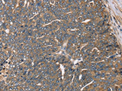 The image on the left is immunohistochemistry of paraffin-embedded Human cervical cancer tissue using CSB-PA950658(HSD17B12 Antibody) at dilution 1/30, on the right is treated with fusion protein. (Original magnification: x200) The image on the left is immunohistochemistry of paraffin-embedded Human cervical cancer tissue using CSB-PA950658(HSD17B12 Antibody) at dilution 1/30, on the right is treated with fusion protein. (Original magnification: x200)