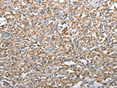 The image on the left is immunohistochemistry of paraffin-embedded Human thyroid cancer tissue using CSB-PA955576(TSC2 Antibody) at dilution 1/25, on the right is treated with synthetic peptide. (Original magnification: x200) The image on the left is immunohistochemistry of paraffin-embedded Human thyroid cancer tissue using CSB-PA955576(TSC2 Antibody) at dilution 1/25, on the right is treated with synthetic peptide. (Original magnification: x200)
