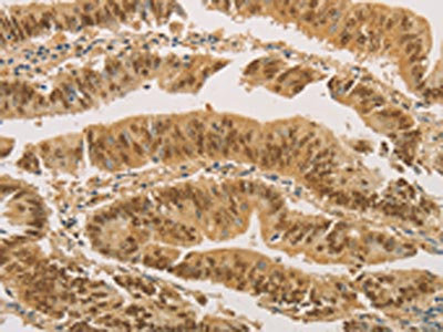 The image on the left is immunohistochemistry of paraffin-embedded Human colon cancer tissue using CSB-PA955584(PSMB7 Antibody) at dilution 1/20, on the right is treated with fusion protein. (Original magnification: x200)