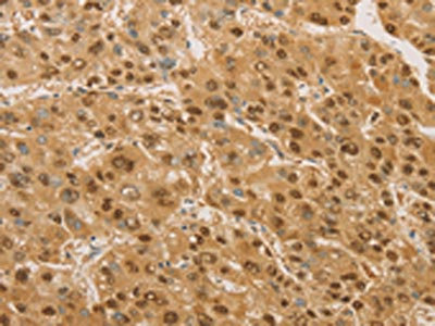 The image on the left is immunohistochemistry of paraffin-embedded Human liver cancer tissue using CSB-PA955584(PSMB7 Antibody) at dilution 1/20, on the right is treated with fusion protein. (Original magnification: x200) The image on the left is immunohistochemistry of paraffin-embedded Human liver cancer tissue using CSB-PA955584(PSMB7 Antibody) at dilution 1/20, on the right is treated with fusion protein. (Original magnification: x200)