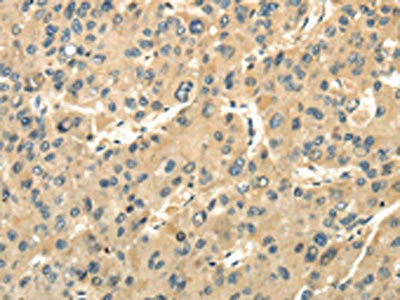 The image on the left is immunohistochemistry of paraffin-embedded Human liver cancer tissue using CSB-PA955770(UBAP1 Antibody) at dilution 1/20, on the right is treated with fusion protein. (Original magnification: x200) The image on the left is immunohistochemistry of paraffin-embedded Human liver cancer tissue using CSB-PA955770(UBAP1 Antibody) at dilution 1/20, on the right is treated with fusion protein. (Original magnification: x200)