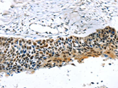 The image on the left is immunohistochemistry of paraffin-embedded Human esophagus cancer tissue using CSB-PA955880(TRERF1 Antibody) at dilution 1/20, on the right is treated with synthetic peptide. (Original magnification: x200) The image on the left is immunohistochemistry of paraffin-embedded Human esophagus cancer tissue using CSB-PA955880(TRERF1 Antibody) at dilution 1/20, on the right is treated with synthetic peptide. (Original magnification: x200)