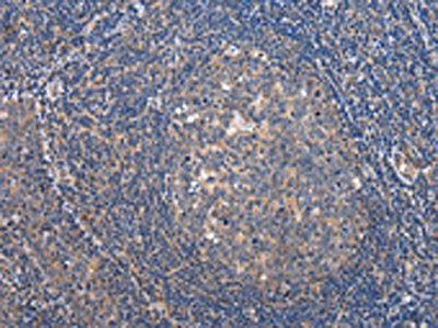 The image on the left is immunohistochemistry of paraffin-embedded Human tonsil tissue using CSB-PA958000(ARFGAP2 Antibody) at dilution 1/35, on the right is treated with synthetic peptide. (Original magnification: x200)
