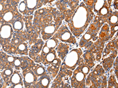 The image on the left is immunohistochemistry of paraffin-embedded Human thyroid cancer tissue using CSB-PA958000(ARFGAP2 Antibody) at dilution 1/35, on the right is treated with synthetic peptide. (Original magnification: x200)