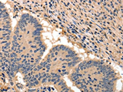 The image on the left is immunohistochemistry of paraffin-embedded Human colon cancer tissue using CSB-PA961022(BAIAP2 Antibody) at dilution 1/50, on the right is treated with fusion protein. (Original magnification: x200) The image on the left is immunohistochemistry of paraffin-embedded Human colon cancer tissue using CSB-PA961022(BAIAP2 Antibody) at dilution 1/50, on the right is treated with fusion protein. (Original magnification: x200)