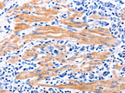 The image on the left is immunohistochemistry of paraffin-embedded Human stomach cancer tissue using CSB-PA971102(GDF9 Antibody) at dilution 1/7, on the right is treated with fusion protein. (Original magnification: x200) The image on the left is immunohistochemistry of paraffin-embedded Human stomach cancer tissue using CSB-PA971102(GDF9 Antibody) at dilution 1/7, on the right is treated with fusion protein. (Original magnification: x200)