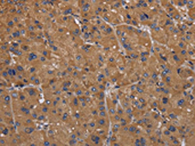 The image on the left is immunohistochemistry of paraffin-embedded Human liver cancer tissue using CSB-PA978301(FADS1 Antibody) at dilution 1/50, on the right is treated with fusion protein. (Original magnification: x200)