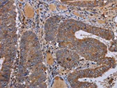 The image on the left is immunohistochemistry of paraffin-embedded Human colon cancer tissue using CSB-PA978301(FADS1 Antibody) at dilution 1/50, on the right is treated with fusion protein. (Original magnification: x200)