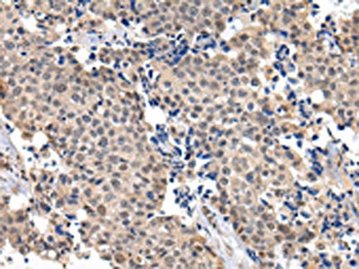 The image on the left is immunohistochemistry of paraffin-embedded Human breast cancer tissue using CSB-PA980290(USF1 Antibody) at dilution 1/20, on the right is treated with fusion protein. (Original magnification: x200) The image on the left is immunohistochemistry of paraffin-embedded Human breast cancer tissue using CSB-PA980290(USF1 Antibody) at dilution 1/20, on the right is treated with fusion protein. (Original magnification: x200)