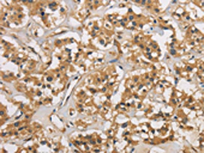 The image is immunohistochemistry of paraffin-embedded Human thyroid cancer tissue using CSB-PA984107(CASP3 Antibody) at dilution 1/30. (Original magnification: x200)