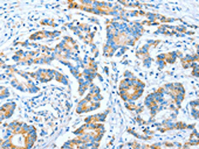 The image on the left is immunohistochemistry of paraffin-embedded Human colon cancer tissue using CSB-PA985538(IMMT Antibody) at dilution 1/70, on the right is treated with fusion protein. (Original magnification: x200)
