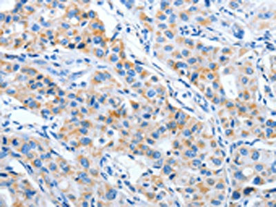 The image on the left is immunohistochemistry of paraffin-embedded Human lung cancer tissue using CSB-PA985538(IMMT Antibody) at dilution 1/70, on the right is treated with fusion protein. (Original magnification: x200)