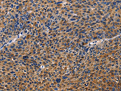 The image on the left is immunohistochemistry of paraffin-embedded Human liver cancer tissue using CSB-PA989887(MUSK Antibody) at dilution 1/40, on the right is treated with fusion protein. (Original magnification: x200)