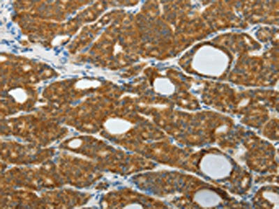 The image on the left is immunohistochemistry of paraffin-embedded Human thyroid cancer tissue using CSB-PA993202(PRDX5 Antibody) at dilution 1/25, on the right is treated with fusion protein. (Original magnification: x200)