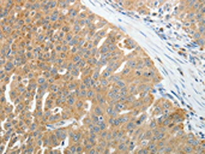The image on the left is immunohistochemistry of paraffin-embedded Human ovarian cancer tissue using CSB-PA993202(PRDX5 Antibody) at dilution 1/25, on the right is treated with fusion protein. (Original magnification: x200) The image on the left is immunohistochemistry of paraffin-embedded Human ovarian cancer tissue using CSB-PA993202(PRDX5 Antibody) at dilution 1/25, on the right is treated with fusion protein. (Original magnification: x200)