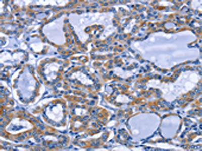 The image on the left is immunohistochemistry of paraffin-embedded Human thyroid cancer tissue using CSB-PA994634(IFNG Antibody) at dilution 1/25, on the right is treated with fusion protein. (Original magnification: x200)