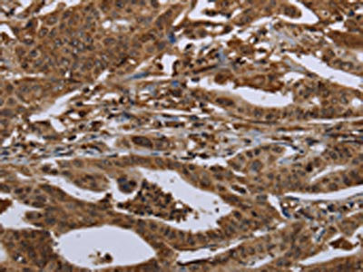 The image on the left is immunohistochemistry of paraffin-embedded Human gastric cancer tissue using CSB-PA994843(HPGD Antibody) at dilution 1/30, on the right is treated with fusion protein. (Original magnification: x200)