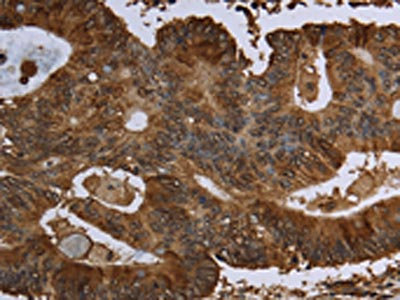 The image on the left is immunohistochemistry of paraffin-embedded Human colon cancer tissue using CSB-PA994843(HPGD Antibody) at dilution 1/30, on the right is treated with fusion protein. (Original magnification: x200)