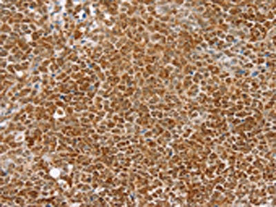 The image on the left is immunohistochemistry of paraffin-embedded Human ovarian cancer tissue using CSB-PA995016(TAF12 Antibody) at dilution 1/30, on the right is treated with fusion protein. (Original magnification: x200)