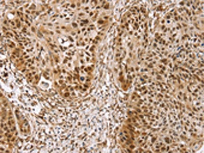 The image on the left is immunohistochemistry of paraffin-embedded Human esophagus cancer tissue using CSB-PA995016(TAF12 Antibody) at dilution 1/30, on the right is treated with fusion protein. (Original magnification: x200)