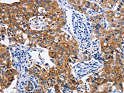 The image on the left is immunohistochemistry of paraffin-embedded Human lung cancer tissue using CSB-PA995781(IFNG Antibody) at dilution 1/30, on the right is treated with fusion protein. (Original magnification: X200)