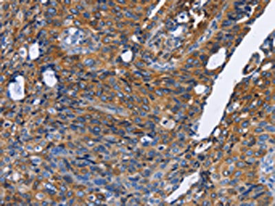 The image on the left is immunohistochemistry of paraffin-embedded Human cervical cancer tissue using CSB-PA995781(IFNG Antibody) at dilution 1/30, on the right is treated with fusion protein. (Original magnification: X200)